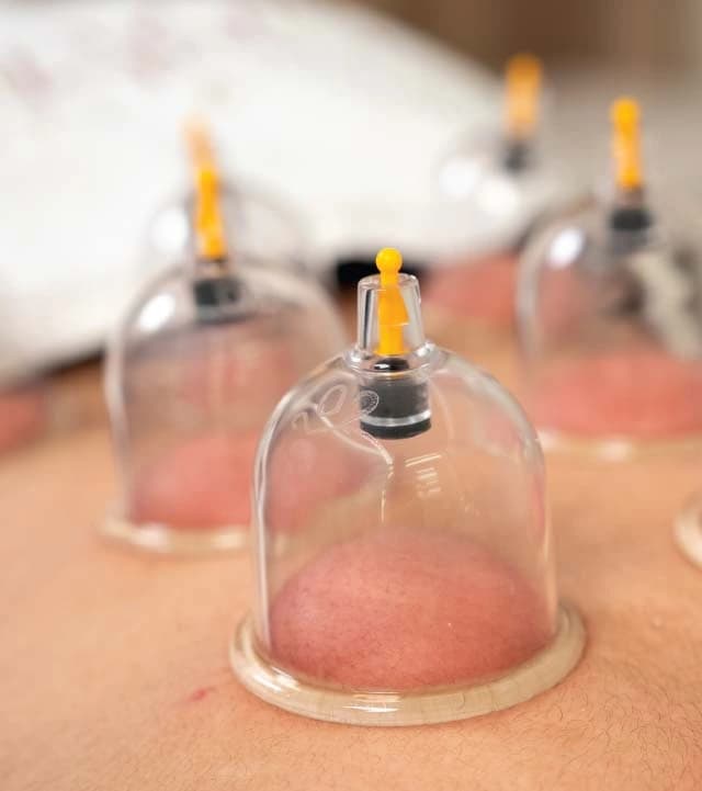 Cupping Therapy